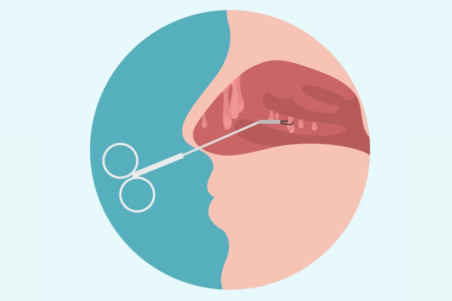 Grafika przedstawiająca przekrój jamy nosowej w trakcie usuwania polipów w nosie.