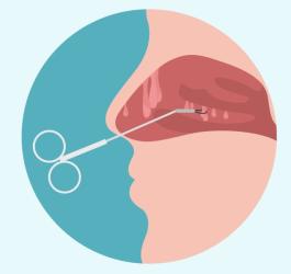 Grafika przedstawiająca przekrój jamy nosowej w trakcie usuwania polipów w nosie.