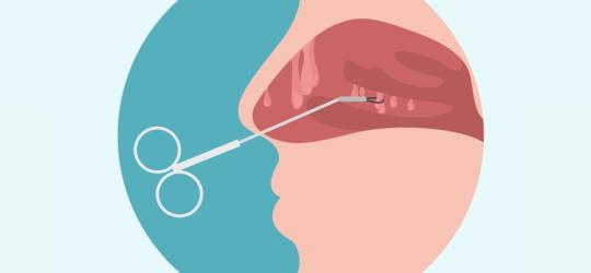 Grafika przedstawiająca przekrój jamy nosowej w trakcie usuwania polipów w nosie.