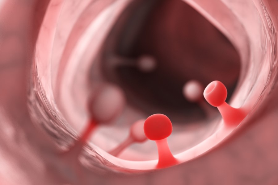 Polipy jelita grubego w powiększeniu.