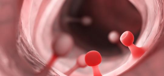 Polipy jelita grubego w powiększeniu.