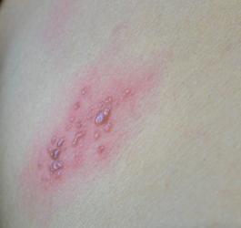 Skóra z objawami półpaśca, czyli pęcherzykowatą wysypką w obrębie nerwów międzyżebrowych.