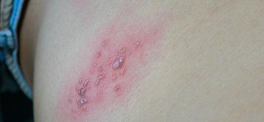Skóra z objawami półpaśca, czyli pęcherzykowatą wysypką w obrębie nerwów międzyżebrowych.