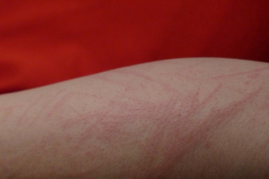 Zbliżenie na podrażnioną skórę przedramienia.