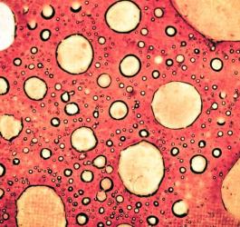 Komórki rakowe w powiększeniu.