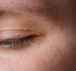 Zbliżenie na oko. Na skórze powiek i wokół oka widoczne niewielkie prosaki.