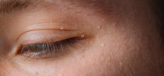 Zbliżenie na oko. Na skórze powiek i wokół oka widoczne niewielkie prosaki.