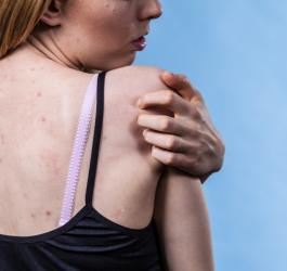 Pryszcze na plecach - jak leczyć?