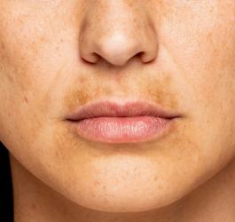 Zbliżenie na twarz kobiety z widocznymi przebarwieniami skórnymi.