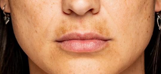 Zbliżenie na twarz kobiety z widocznymi przebarwieniami skórnymi.