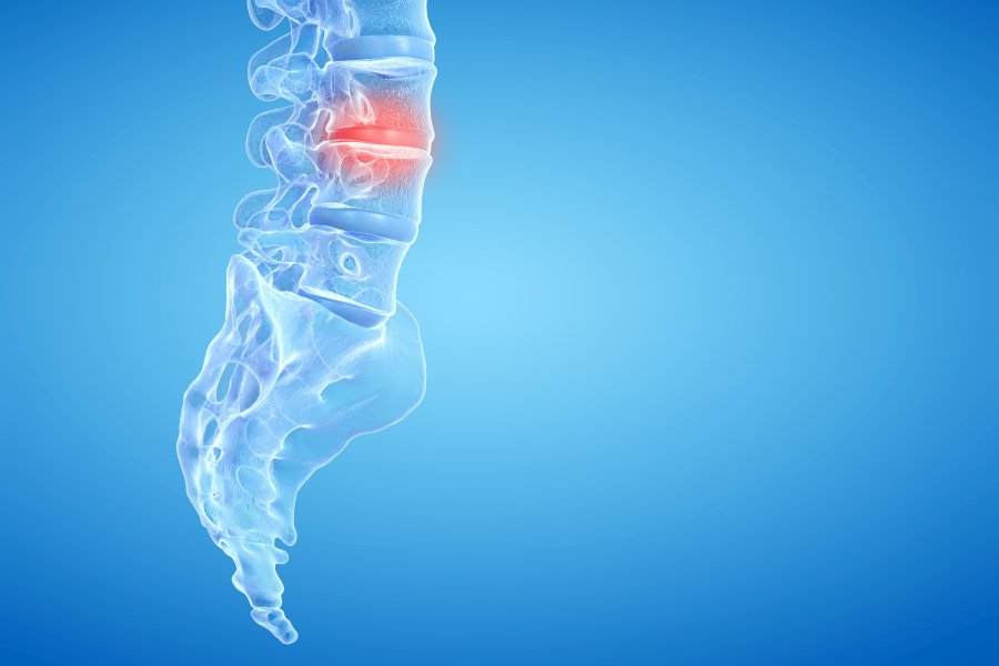 Przepuklina kręgosłupa - objawy