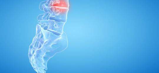 Przepuklina kręgosłupa - objawy