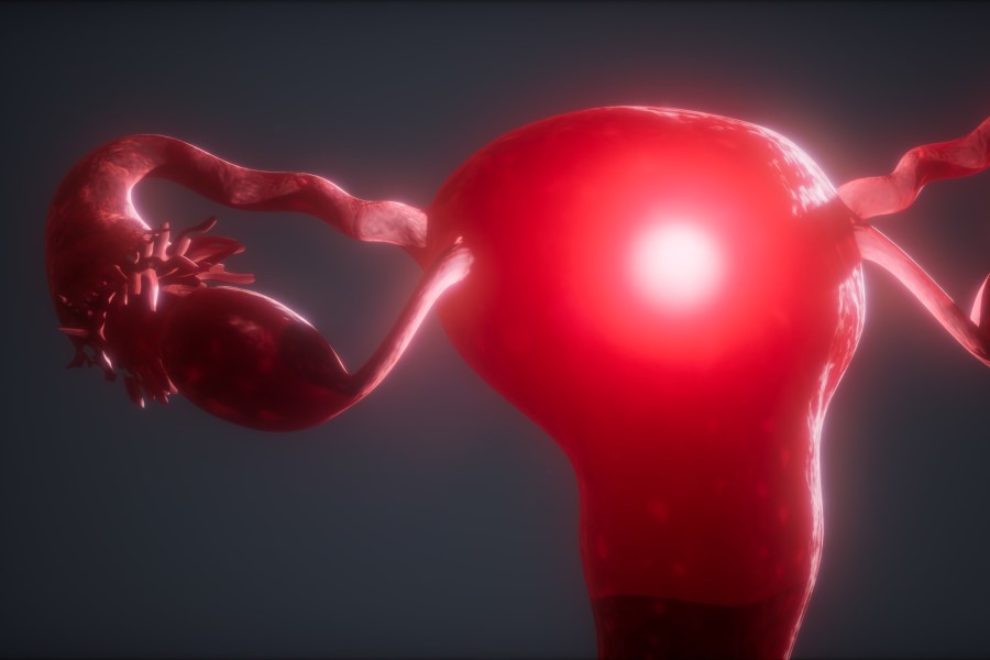 Model 3D macicy z zasygnalizowanym rakiem endometrium.