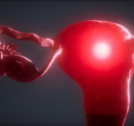 Model 3D macicy z zasygnalizowanym rakiem endometrium.