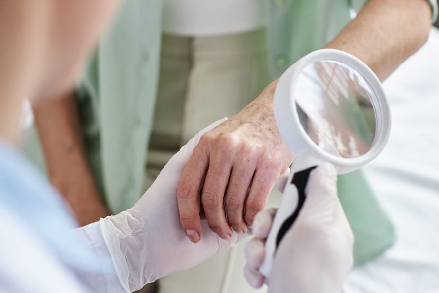 Lekarz diagnozuje pacjenta w kierunku raka płaskonabłonkowego skóry.