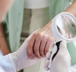 Lekarz diagnozuje pacjenta w kierunku raka płaskonabłonkowego skóry.