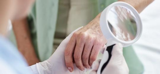 Lekarz diagnozuje pacjenta w kierunku raka płaskonabłonkowego skóry.