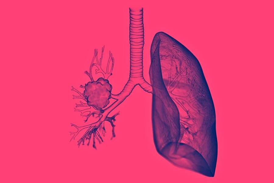 Model ludzkich płuc z widocznym z jednej strony rakiem płuca.