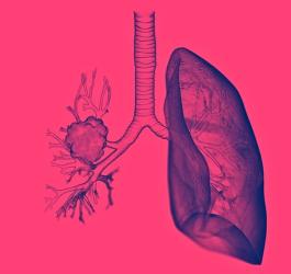 Model ludzkich płuc z widocznym z jednej strony rakiem płuca.