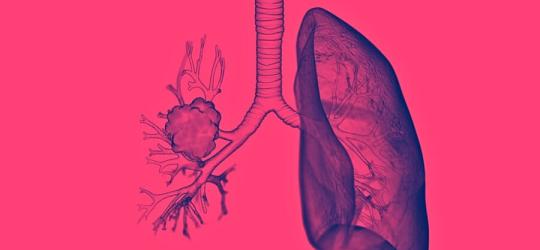 Model ludzkich płuc z widocznym z jednej strony rakiem płuca.