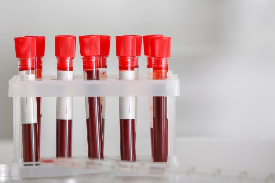 Fiolki z krwią pacjenta przeznaczone do badania morfologii krwi, w tym parametru RDW-SD.