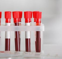 Fiolki z krwią pacjenta przeznaczone do badania morfologii krwi, w tym parametru RDW-SD.