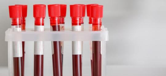 Fiolki z krwią pacjenta przeznaczone do badania morfologii krwi, w tym parametru RDW-SD.