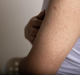 Zbliżenie na ramię z widocznym rogowaceniem okołomieszkowym.