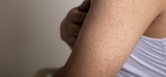 Zbliżenie na ramię z widocznym rogowaceniem okołomieszkowym.