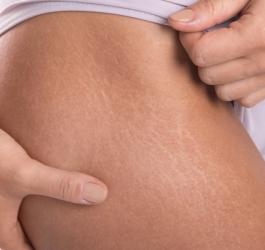 Rozstępy - czy można się ich pozbyć?