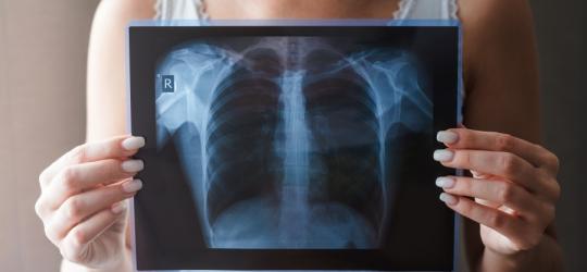 Kobieta trzyma przed sobą zdjęcie RTG płuc.