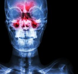 Zdjęcie RTG zatok. Zatoki zaznaczono na czerwono.