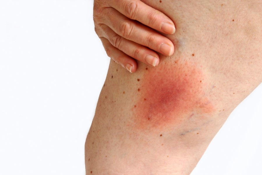 Sporych rozmiarów rumień po kleszczu na powierzchni skóry.