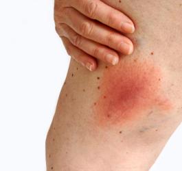 Sporych rozmiarów rumień po kleszczu na powierzchni skóry.