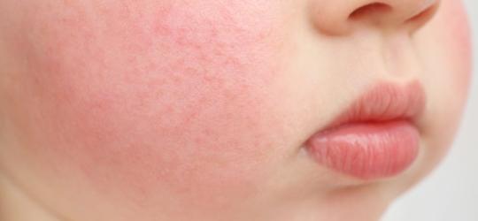 Rumień zakaźny – objawy i leczenie