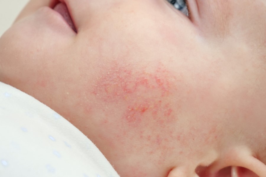 Zaczerwieniona zmiana skórna na policzku niemowlęcia, objaw skazy białkowej u dziecka.
