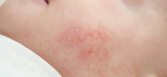 Zaczerwieniona zmiana skórna na policzku niemowlęcia, objaw skazy białkowej u dziecka.