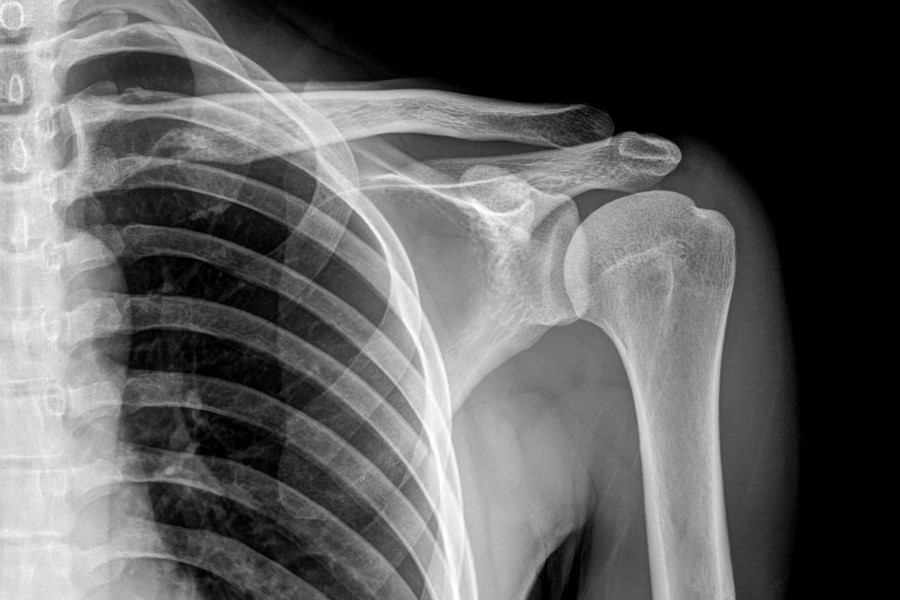 RTG klatki piersiowej i ramienia. RTG wykorzystuje się w diagnostyce sklerotyzacji podchrzęstnej.