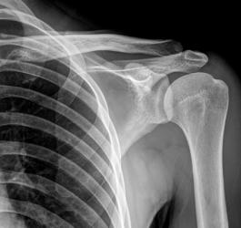 RTG klatki piersiowej i ramienia. RTG wykorzystuje się w diagnostyce sklerotyzacji podchrzęstnej.