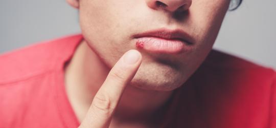 Skuteczne metody leczenia opryszczki