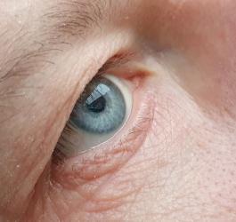 Skuteczne metody leczenia zaćmy