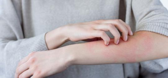 Świerzb − objawy, diagnoza, leczenie