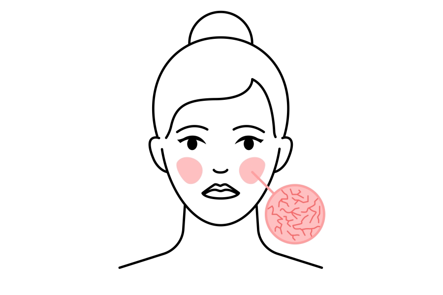 Teleangiektazje - jak walczyć z naczynkami na skórze?