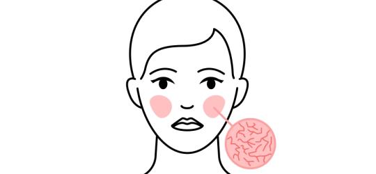 Teleangiektazje - jak walczyć z naczynkami na skórze?