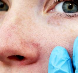 Toczeń rumieniowaty - co to za choroba?