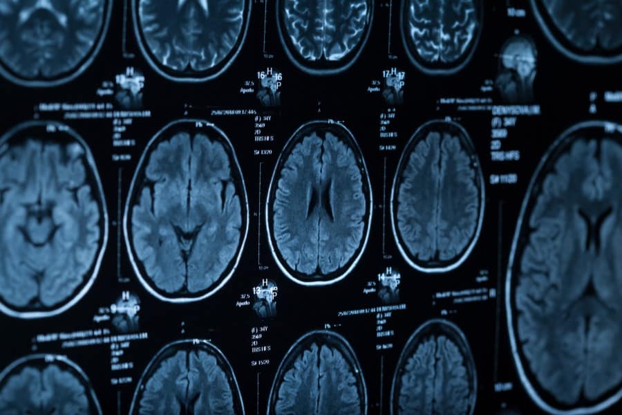 Zdjęcie tomografii komputerowej głowy.