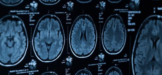 Zdjęcie tomografii komputerowej głowy.