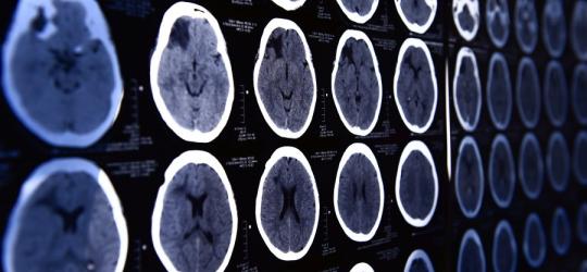 Tomografia komputerowa - na czym polega i kiedy się ją wykonuje?