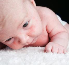 Niemowlę z widocznym na buzi trądzikiem niemowlęcym.