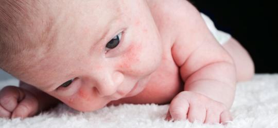 Niemowlę z widocznym na buzi trądzikiem niemowlęcym.